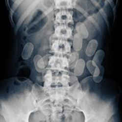 Mattoni X-Ray